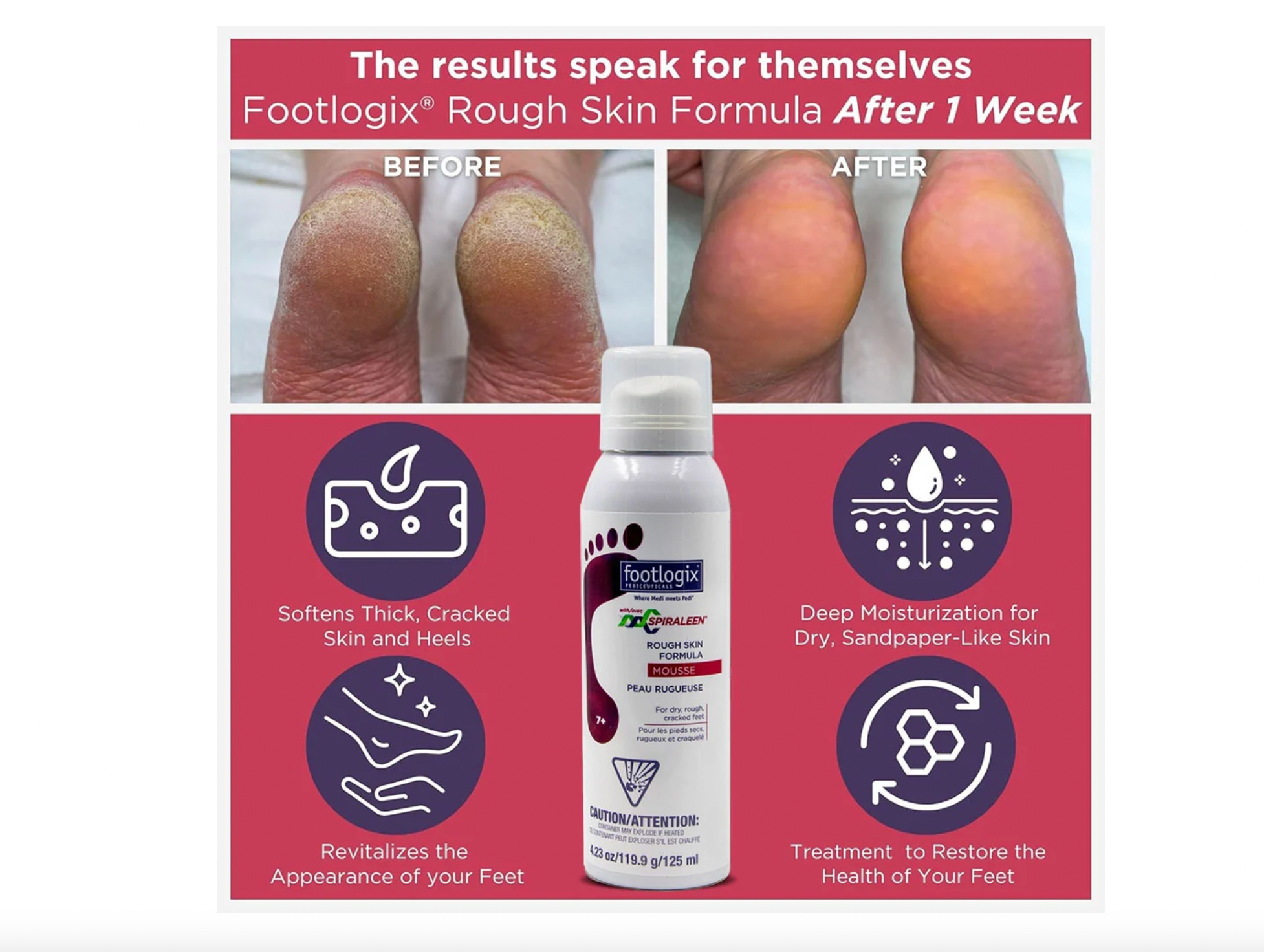 Footlogix Rough Skin Formula Mousse 4.23 oz.