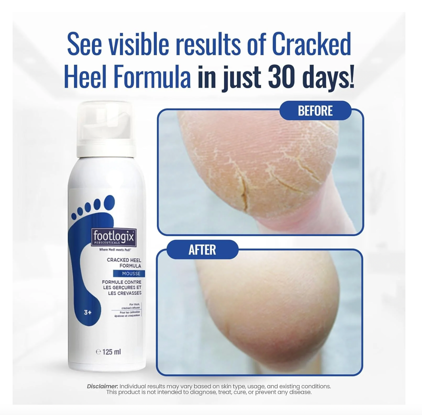 Footlogix Cracked Heel Formula Mousse 4.23 oz.